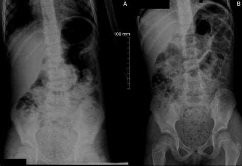 Abdominal X Rays In The Standing A And Supine B Position