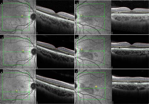 Macular Spectral Domain Optical Coherence Tomography Segmentation