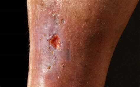 Why Is My Leg Ulcer Not Healing What You Need To Know
