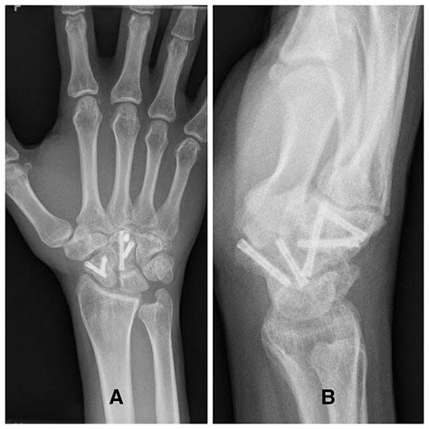 Cureus Open Trans Scaphoid Transcapitate Perilunate Fracture Dislocation A Case Report