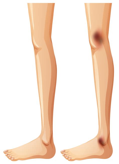 Human Legs And Bruise On White Background 296916 Vector Art At Vecteezy