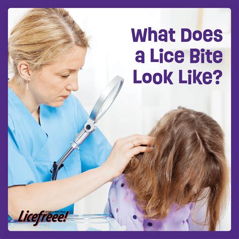 What Does A Lice Bite Look Like Licefreee