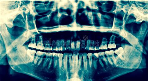 Dental X Ray A Panoramic X Ray Of A Mouth With Intact Wisdom T Stock
