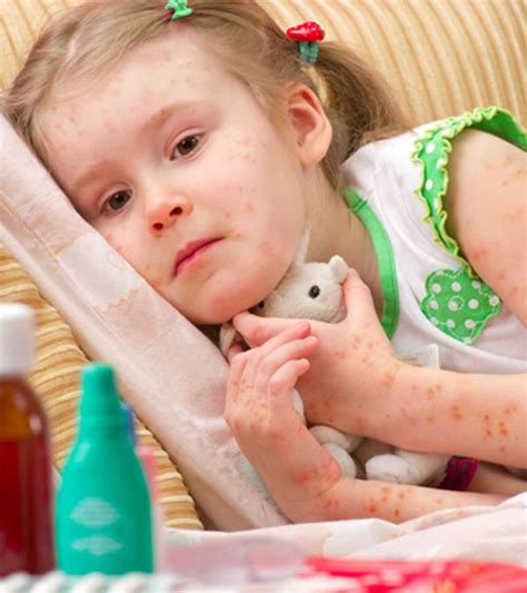 Folliculitis In Children Causes Symptoms And Treatment