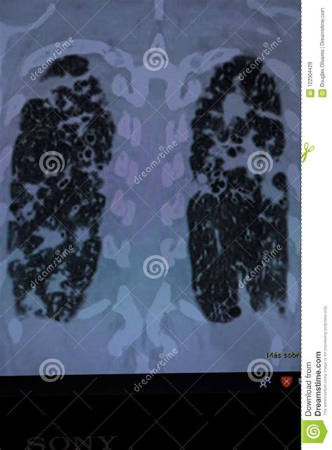 Bronchiectasis And Pulmonary Tb Stock Image Image Of Healthcare