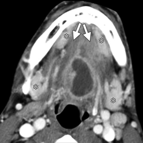 Abscess Of The Root Of The Tongue Contrast Enhanced Ct Scan Shows A