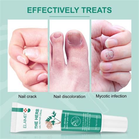 Anti Fungal Cream Nail Fungus Treatment 20g Nail Repair Cream Antifungal And Paronychia