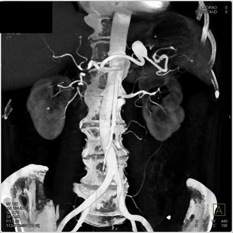 Splenic Artery Aneurysm Spleen Case Studies Ctisus Ct Scanning