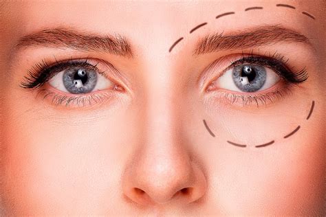 Ptosis Correction Or Droopy Eye Lid Surgery Hong Plastic Surgery Clinic