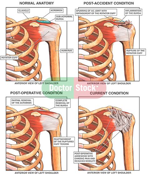 Traumatic Injury To The Shoulder With Capsulitis Doctor Stock