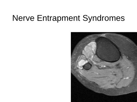 Pdf Nerve Entrapment Syndromes Ucsd Musculoskeletal Radiology