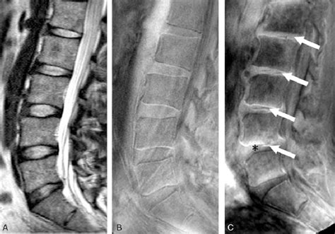 Sagittal Magnetic Resonance Imaging Mri Of The Lumbar Spine A