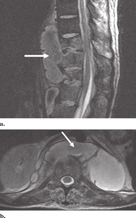 Retrocrural Paraspinal Abscess Due To M Avium Intracellulare Infection