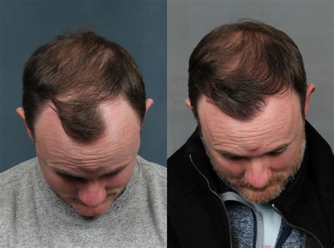 Neograft Hair Transplant Before And After Photo Gallery Louisville Ky Calospa® Rejuvenation