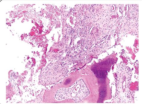 Histology Showed Chronic Inflamed Granulation Tissue Degenerate Bone