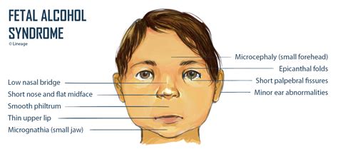 Download scientific diagram | flat nasal bridge and bilateral epicanthal fold. Teratogens / Fetal Alcohol Syndrome - Embryology ...