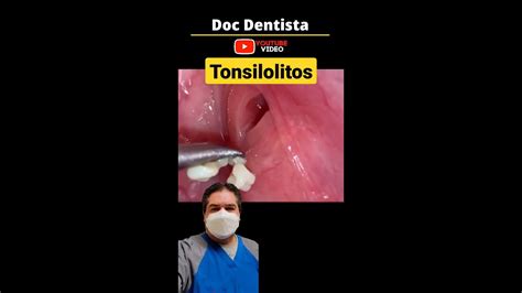 Tonsilolitos Bolitas Blancas Escondidas Dentro De Las Amígdalas Y