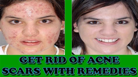 Remove Acne Scars How To Get Rid Of Acne Scars With Home Remedies