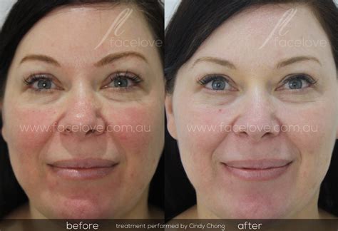 Facial Redness Treatment Before And After Facelove