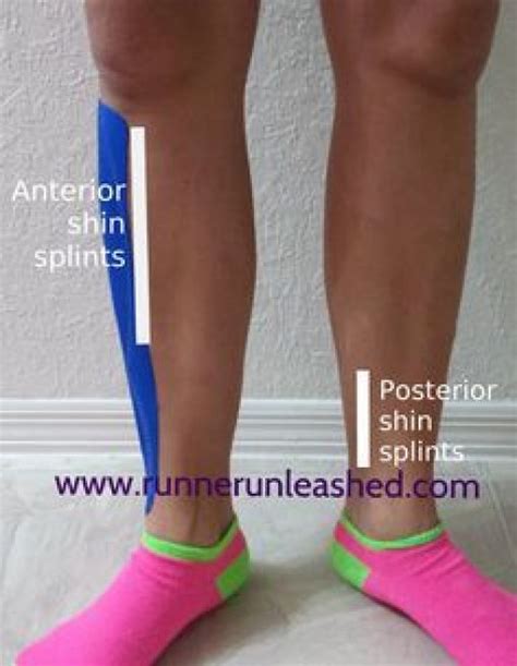 I Hear The Word Shin Splints And I Cringe It Is A Common Running
