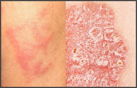 Pictures Of Eczema And Psoriasis Psoriasis Expert