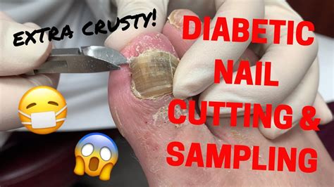Crusty Diabetic Nail Cutting And Fungus Sampling Youtube