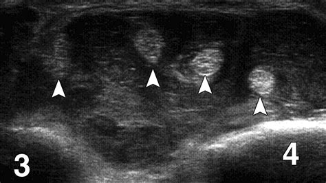 Rheumatoid Arthritis Ultrasound Versus Mri Ajr