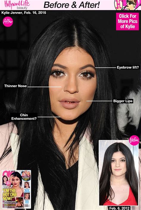 kylie-jenner-before-after-plastic-surgery | kylie Jenner ...