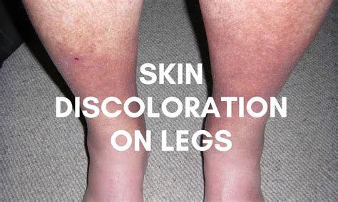 Skin Discoloration On Legs Causes Types And Treatments