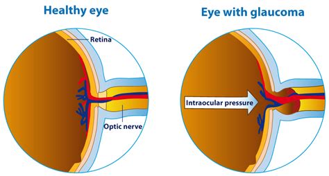 Open Angle Glaucoma Fraser Eye Care Center
