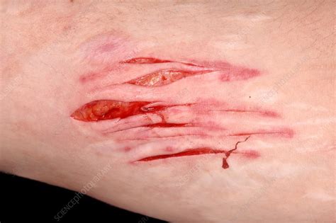 Self Harm Stock Image C0370951 Science Photo Library