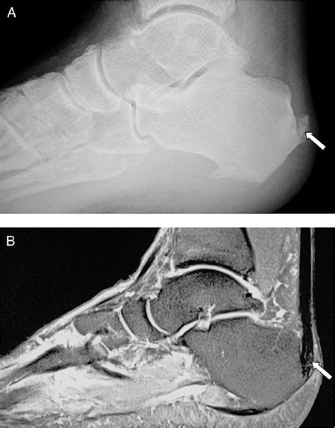 Retrocalcaneal Enthesiopathy Posterior To The Achilles Tendon Insertion