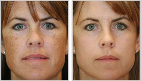 How To Get Rid Of Brown Spots On The Face