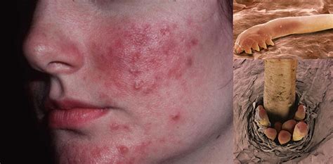 NO es acné es una enfermedad provocada por múltiples PARÁSITOS en la cara