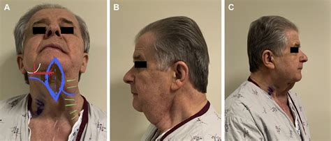 Vertical Submental Island Flap For Head And Neck Reconstruction