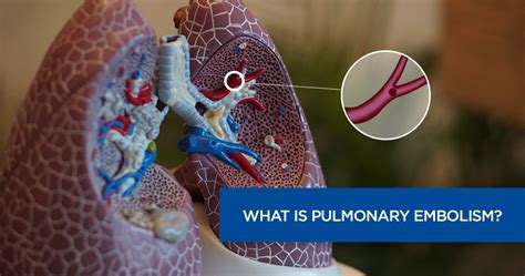 What Is Pulmonary Embolism Causes Symptoms And Diagnosing