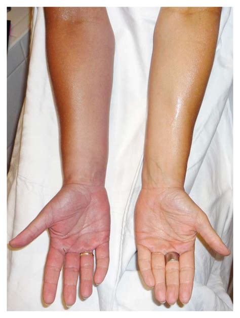 Swelling And Red Discoloration Of The Right Arm And Hand Manual Of