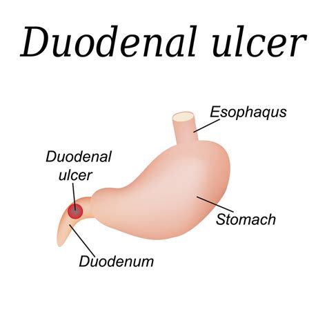 Duodenal Ulcer Pictures
