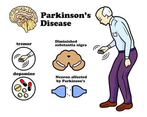 Parkinsons Disease Symptoms And Treatment — Teletype