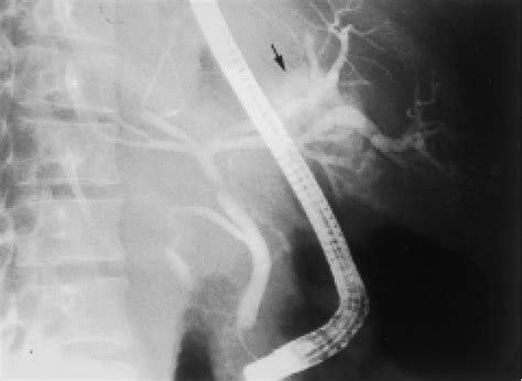 Endoscopic Retrograde Cholangiography Shows Dilated Right Intrahepatic