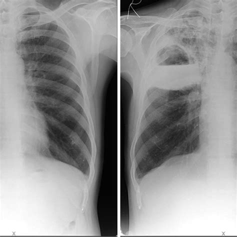 A Chest Radiograph Demonstrating A Large Cavity With Air Fluid Level