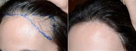 Hair Transplants For Women Before And After Photos Foundation For