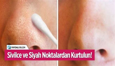 Sivilce Ve Siyah Noktalardan Kurtulun Faydalı Bilgin Siyah