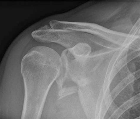 A — X Ray Combined Glenoid And Scapula Fracture Download Scientific