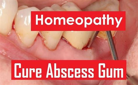 8 Images Tooth Abscess Treatment Homeopathic And Description Alqu Blog