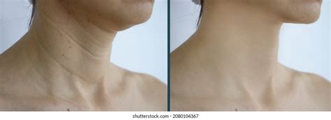 Woman Neck Wrinkles Before After Stock Photo Edit Now 2080104367