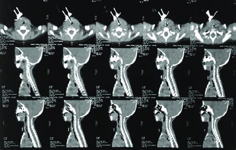 Contrast Enhanced Computerized Tomography Neck Download Scientific