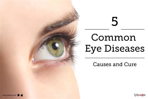 5 Most Common Eye Diseases Causes And Cure By Bharti Eye Hospitals Lybrate