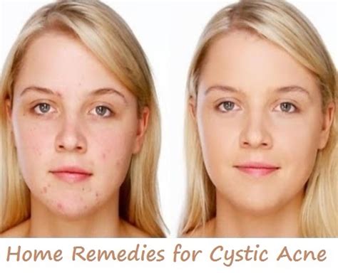 How To Get Rid Of Cystic Acne Active Home Remedies