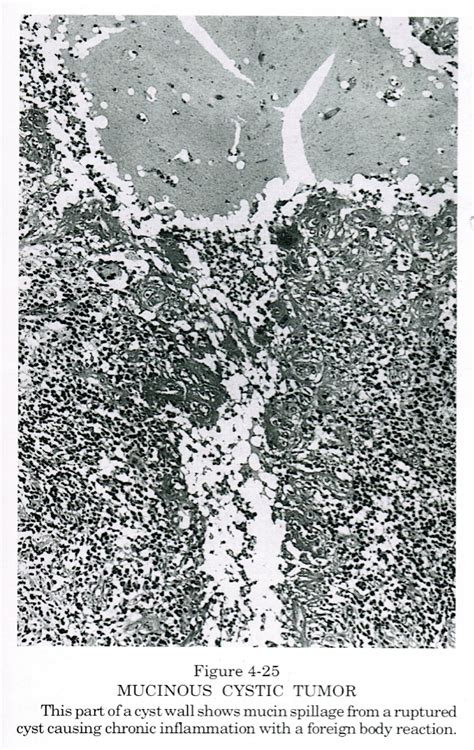 Pathology Outlines Mucinous Cystic Neoplasm